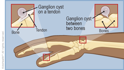 ganglion_a_enil