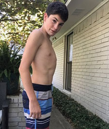 pectus-carinatum-before