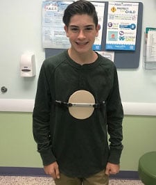 pectus-carinatum-during